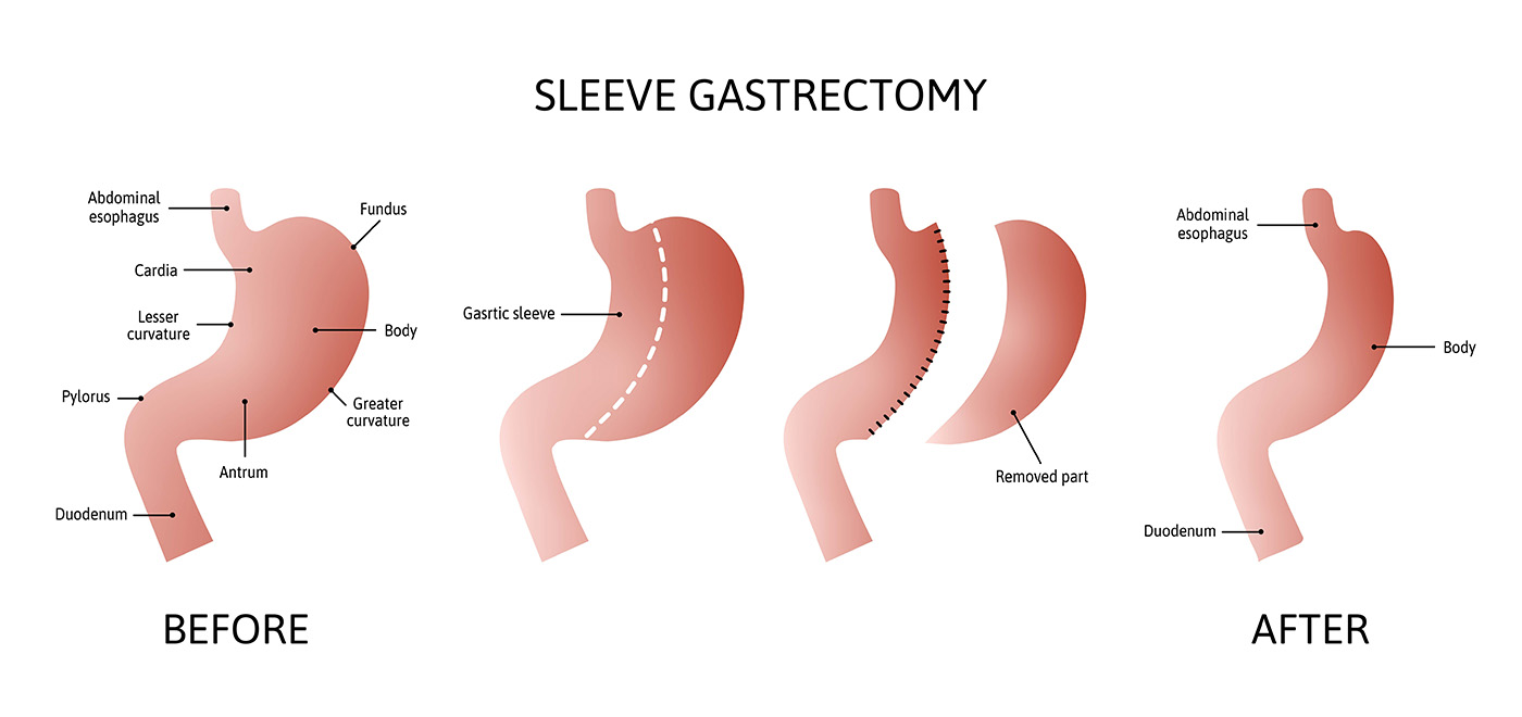 ​Sleeve gastrectomy procedure diagram 
