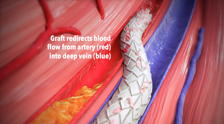 Graphic showing how blood is redirected from an artery into a deep vein using the Limflow device