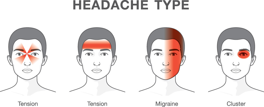 Graphic showing types of headache and location: Tension front of head between eyes. Tension across forehead; Migraine on one side of face; cluster focused over one eye.