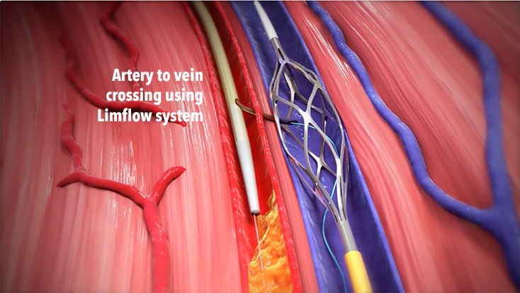 Graphic showing an artery to vein crossing using the LimFlow system